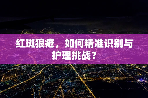红斑狼疮，如何精准识别与护理挑战？